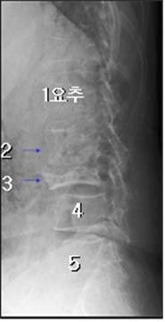 X-선상 제2-3요추가 파괴돼 척추가 휘어지고 척추뼈가 내려 앉아 있다.
