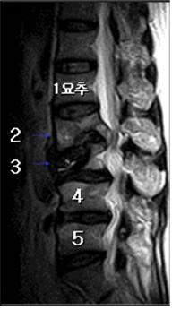 MRI상 제2-3요추 뒤쪽으로는 농양과 파괴된 척추가 신경을 압박하고 있음을 볼 수 있다.