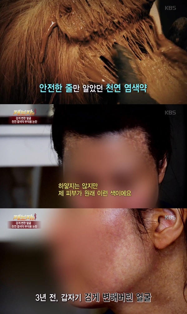 헤나염색 부작용 (사진: KBS2 '제보자들')