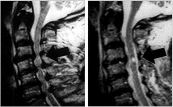 경추증성 척수증 수술 전(왼쪽) 수술 후(오른쪽) 비교 사진. 바로세움병원 제공.