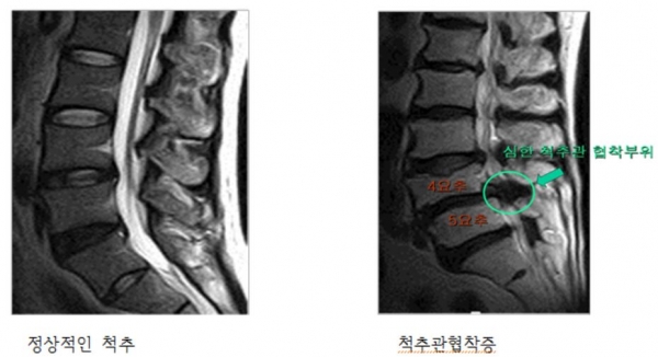 정상적인 척추 MRI 사진에 비하여 척추 뼈의 변형이 심하고 특히 제4-5요추 사이에는 신경관이 막혀 있는 것을 볼 수 있다. 바로세움병원.